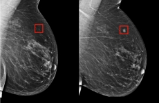 AI less likely to boob in breast exams